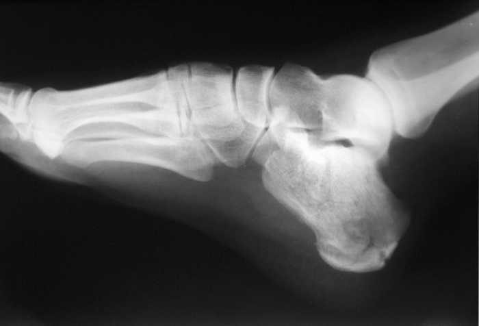 10 Best Shoe After Calcaneal Fracture - Reviews And Buying Guide